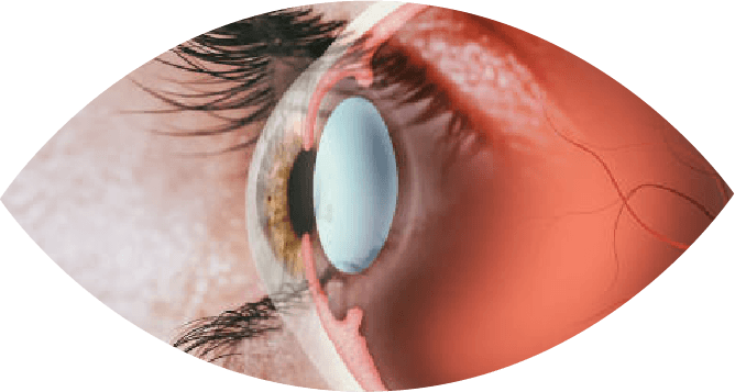 netvlies oogaandoening Heist-op-den-Berg oogarts