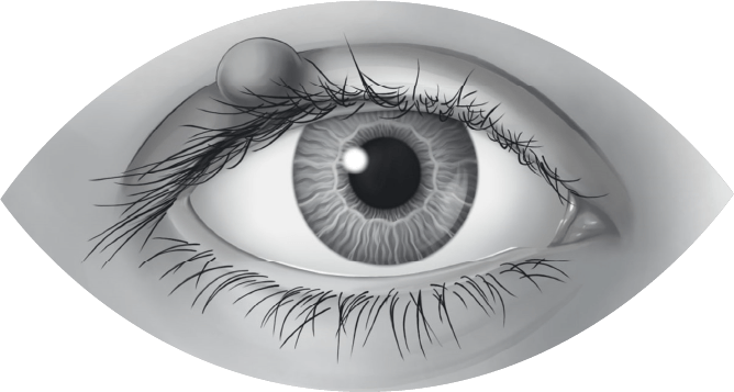 Chalazion oogaandoening oogarts Heist-op-den-Berg